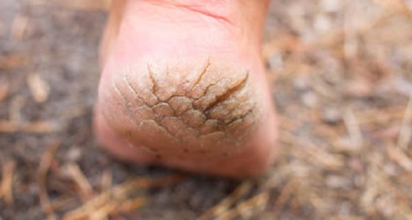 derin topuk çatlağı nasıl geçer