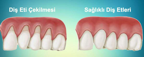 dis-eti-cekilmesi belirtileri nelerdir