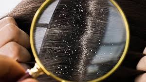 Kepek Neden Olur? Kepek Nasıl Geçer?